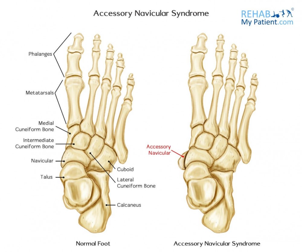 Accessory Navicular Syndrome