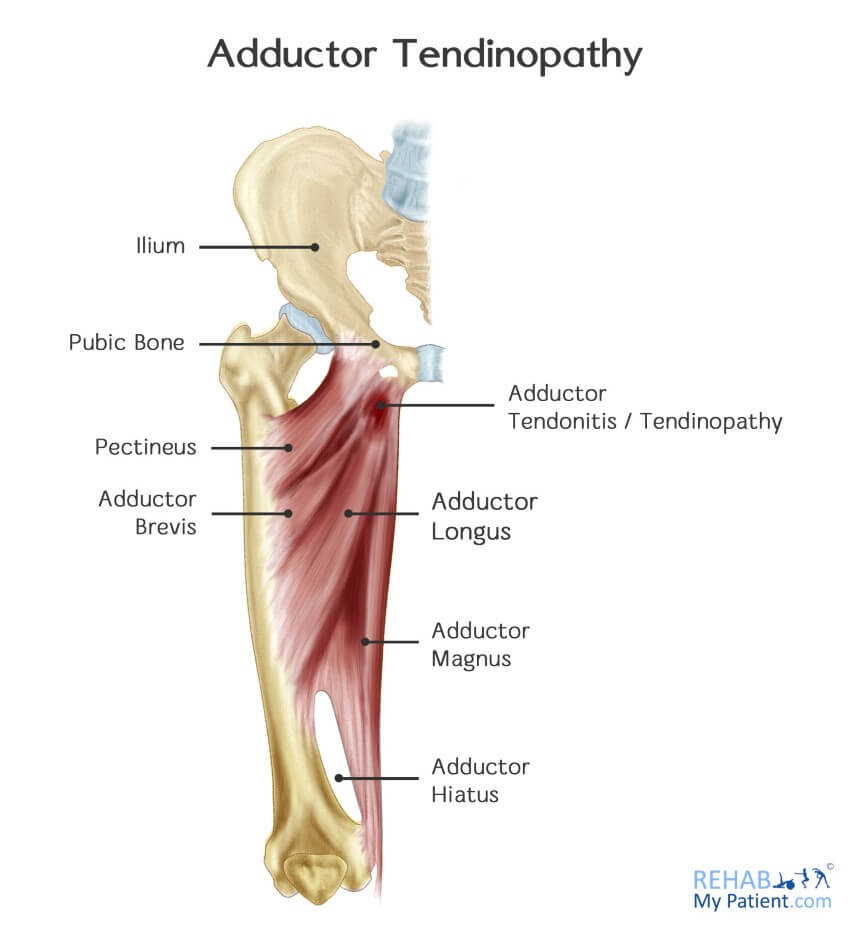Adductor Tendonitis - Groin Inflammation - Symptoms, Treatment & Rehab