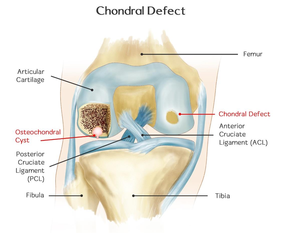 Osteochondral Lesion Rehab My Patient