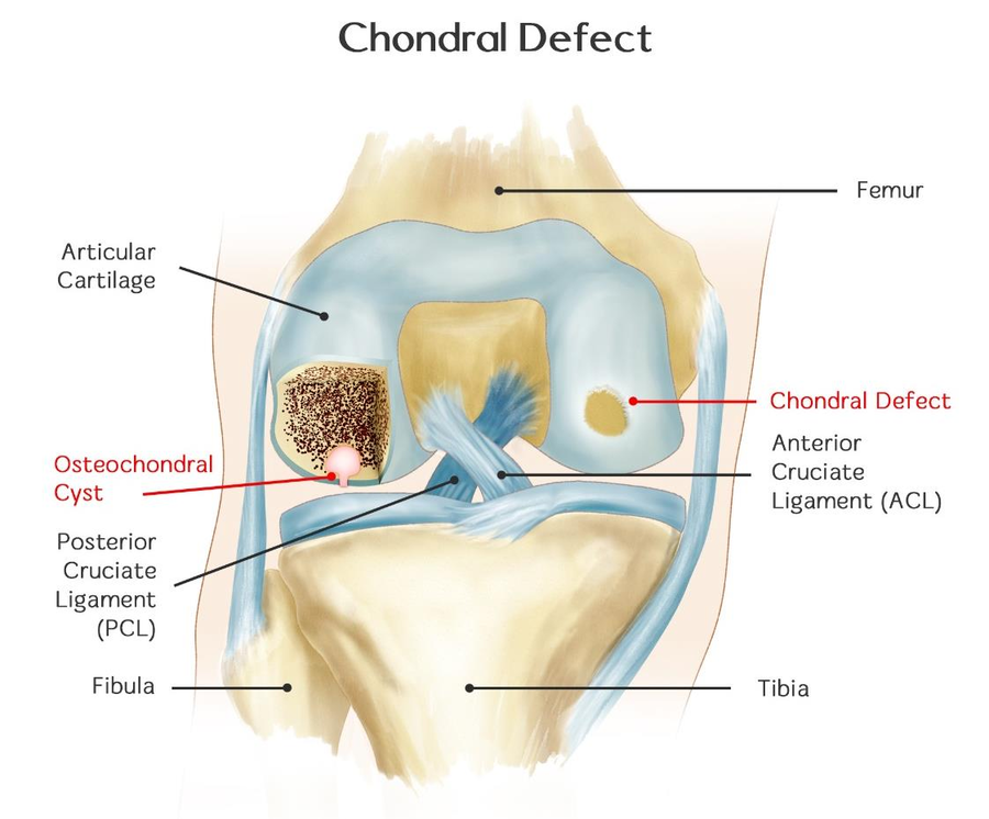 Chondral Defect