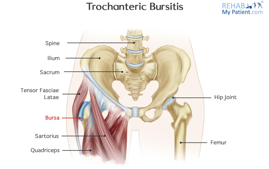 Healthy Street - 🔈 HIP (GREATER TROCHANTERIC) BURSITIS In between tendons  and bones all over the body, small sacs of fluids called bursae are  present. These fluid sacs provide necessary cushion to