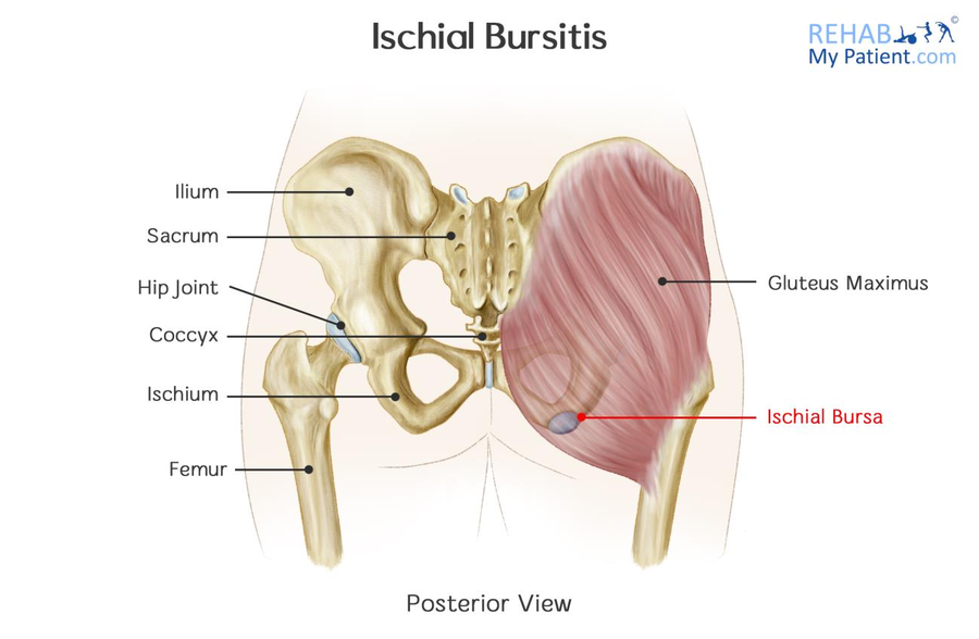 Ischial Bursitis  Rehab My Patient