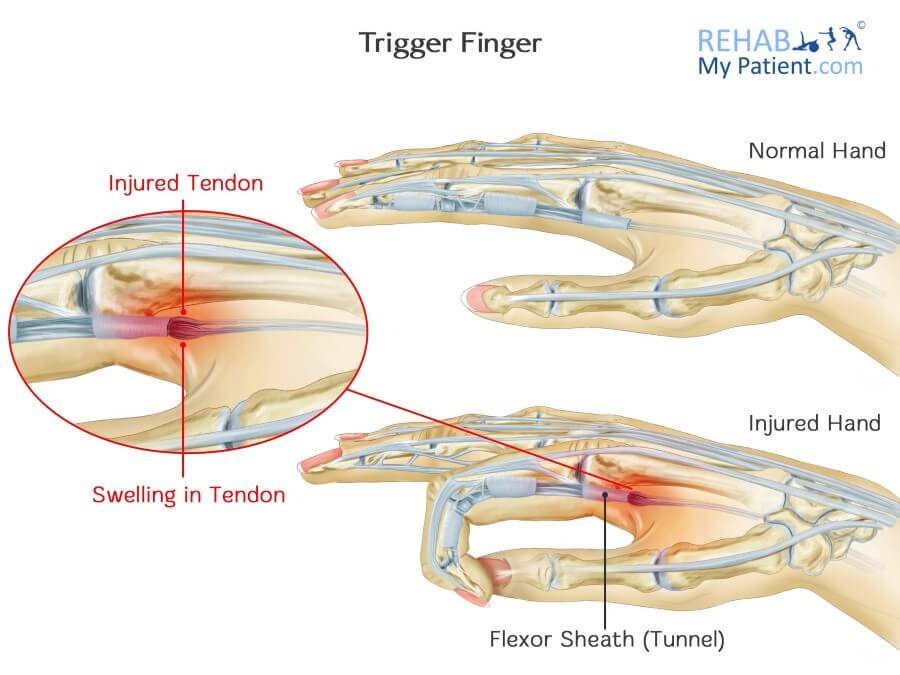 Trigger Finger: Practice Essentials, Background, Anatomy