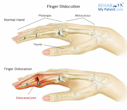 Hand Fingers Thumb Articles 