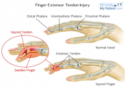 Hand/Fingers/Thumb articles | Rehab My Patient