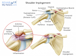 Shoulder articles | Rehab My Patient