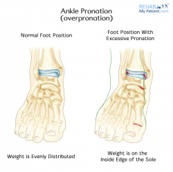 Ankle articles | Rehab My Patient