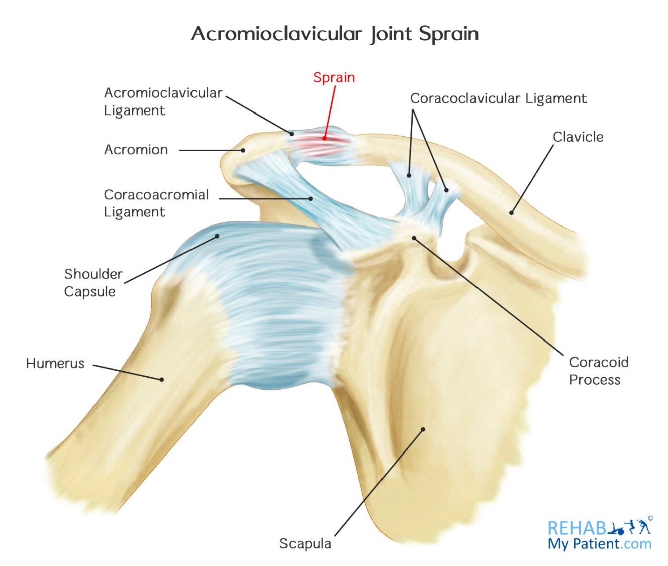 Acromioclavicular Joint Sprain