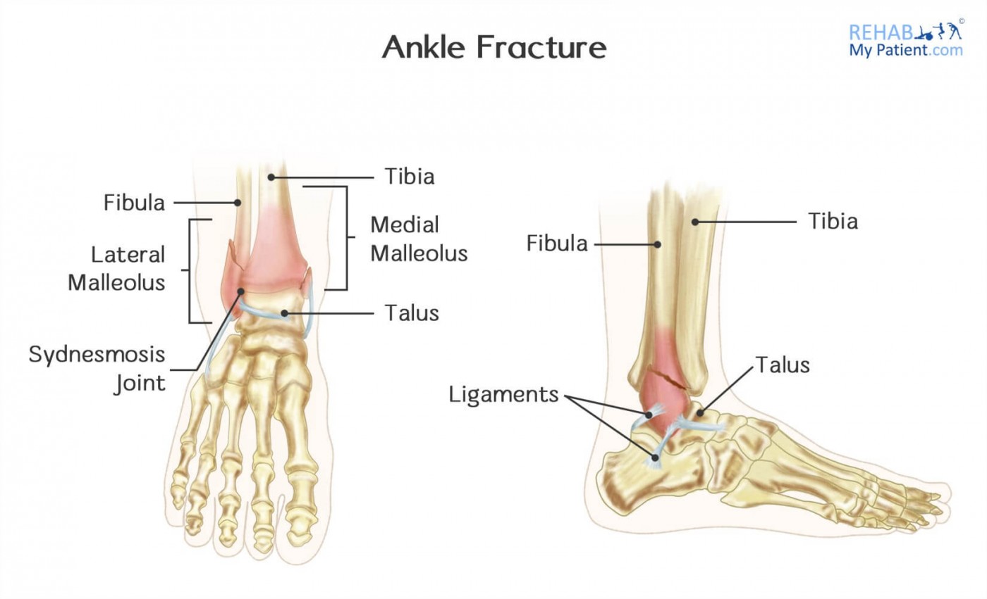 Ankle Fracture  Rehab My Patient