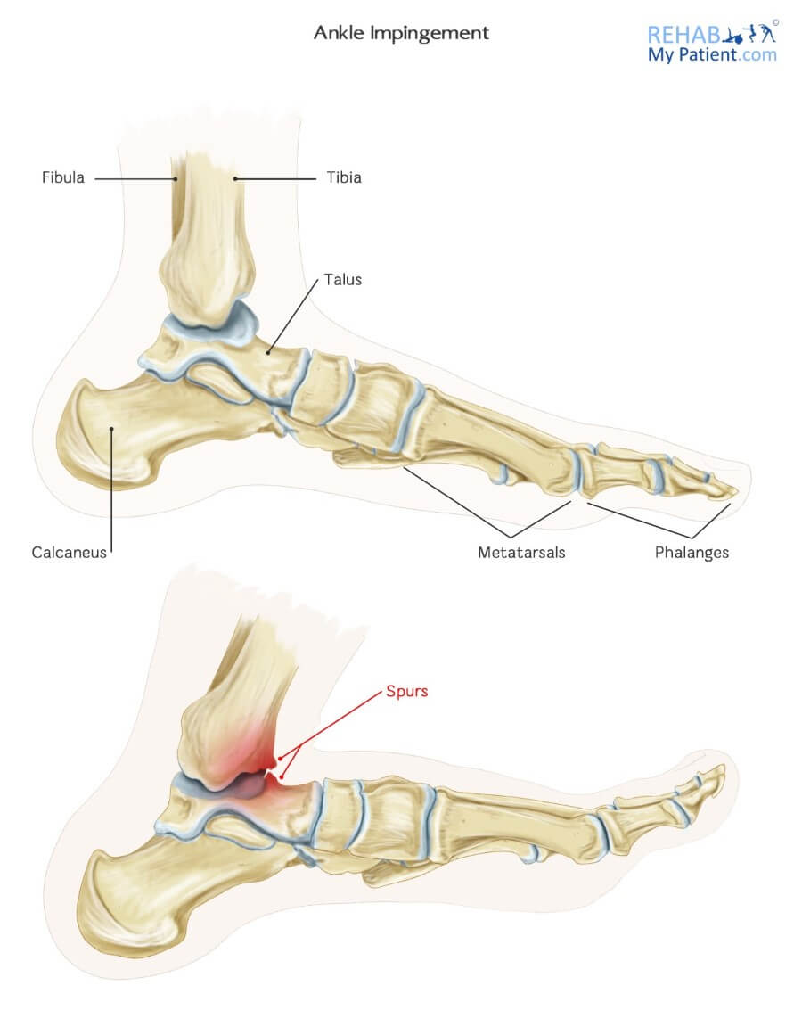 Ankle Impingement (Anterior)