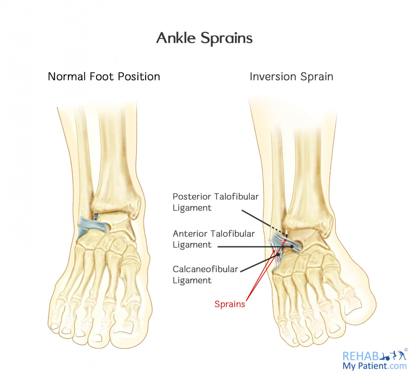 Lateral ankle ligament injury