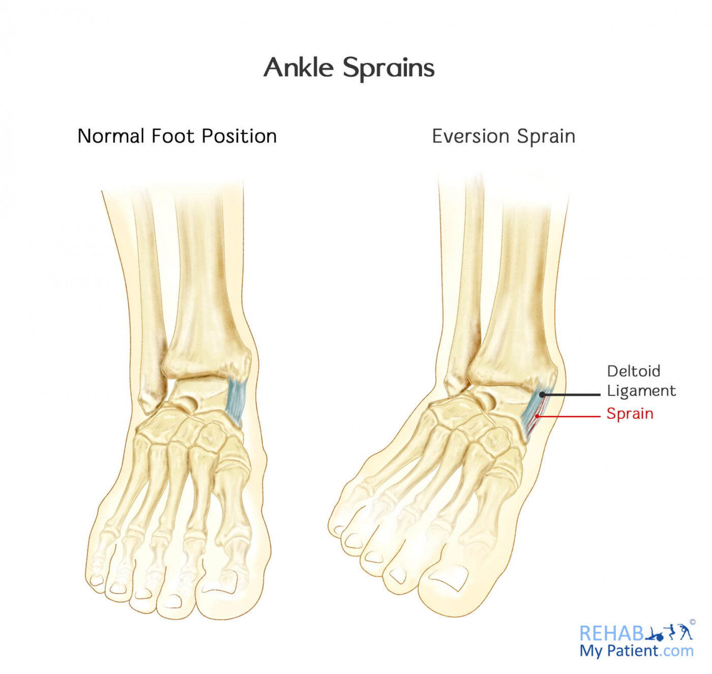 Ankle Sprains Medial And Lateral Rehab My Patient