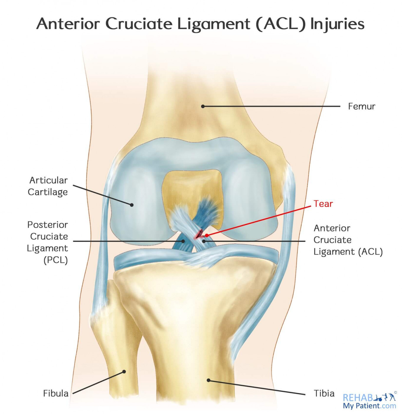 Anterior Cruciate Ligament Acl Injuries Rehab My Patient