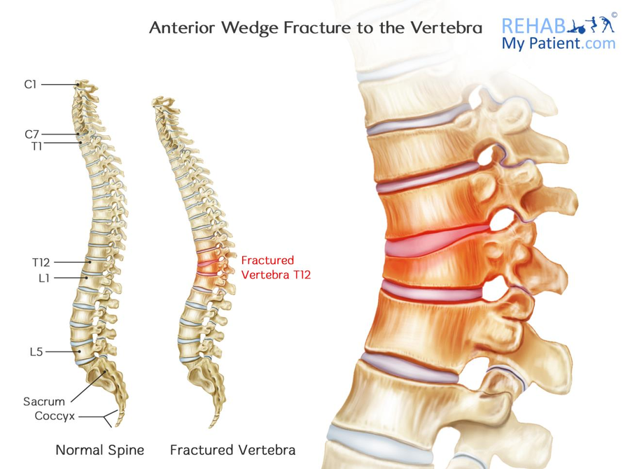 Anterior Wedge Fracture to the Vertebra | Rehab My Patient