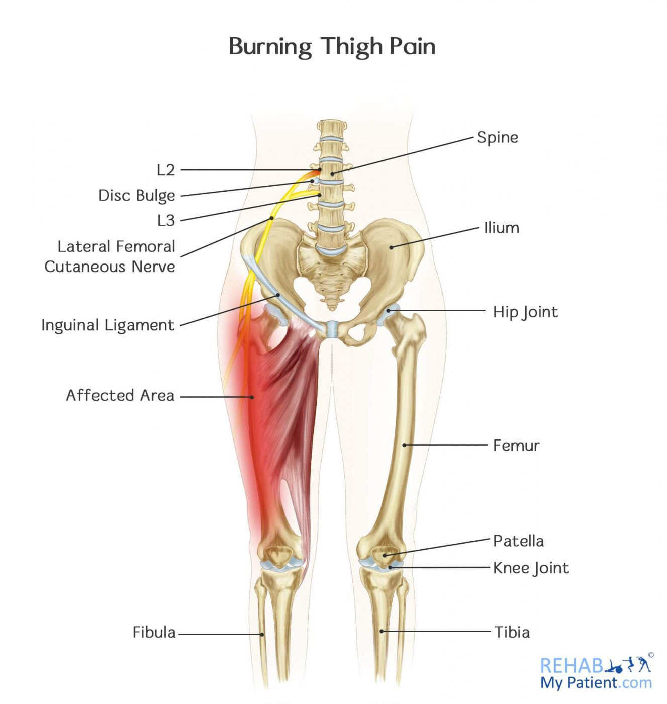 Burning Thigh Pain Rehab My Patient