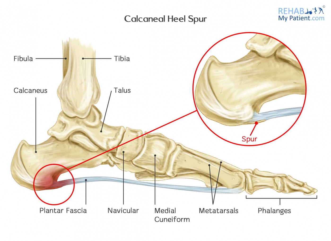 calcaneal spur ankle