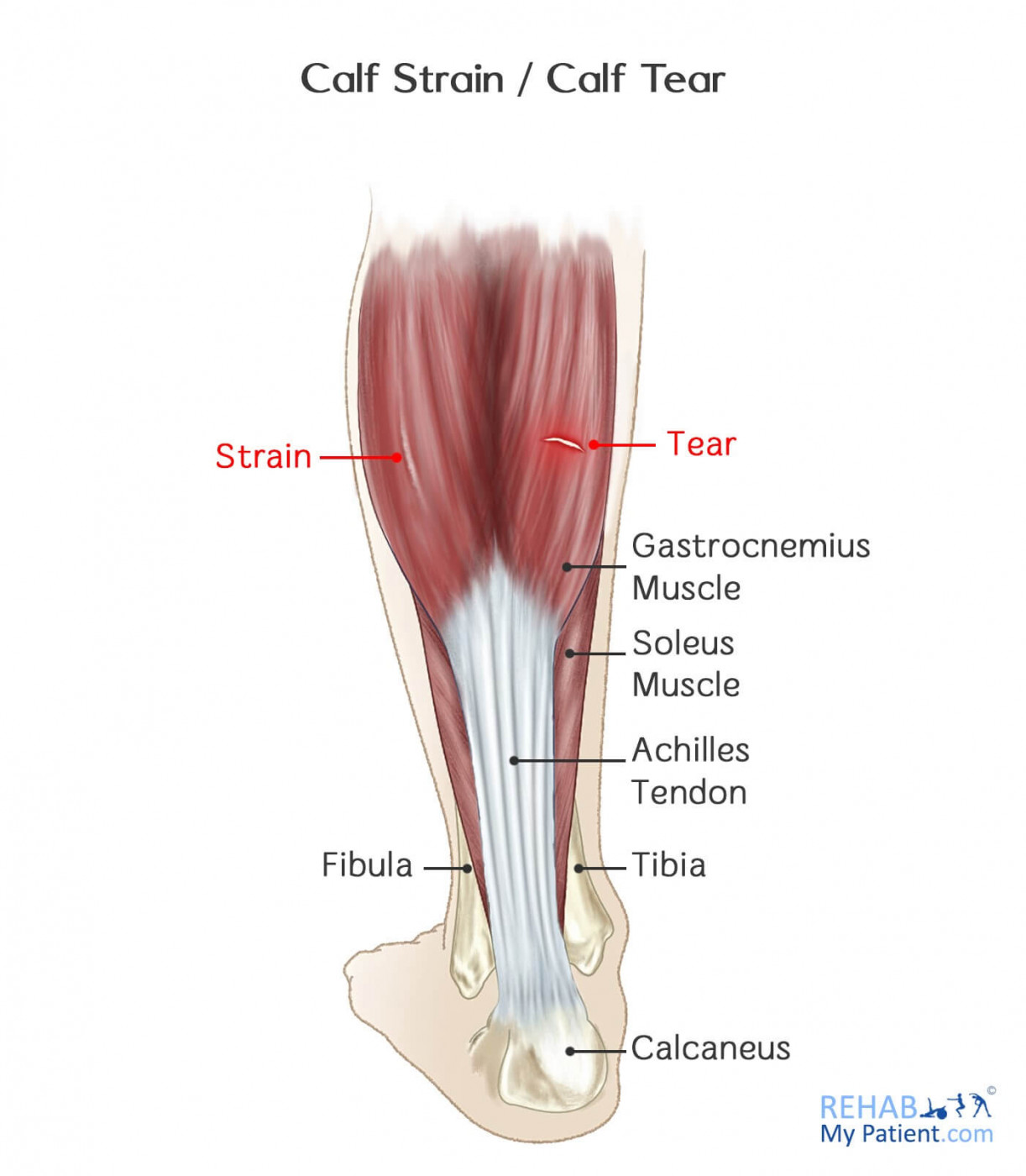 Calf Strain Calf Tear Rehab My Patient