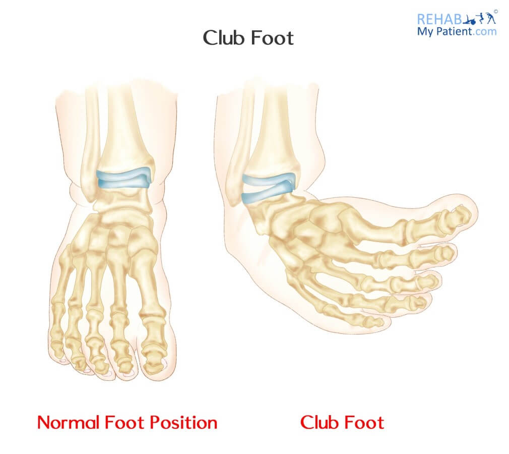 Club Foot Rehab My Patient