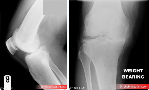 Knee Osteoarthritis | Rehab My Patient
