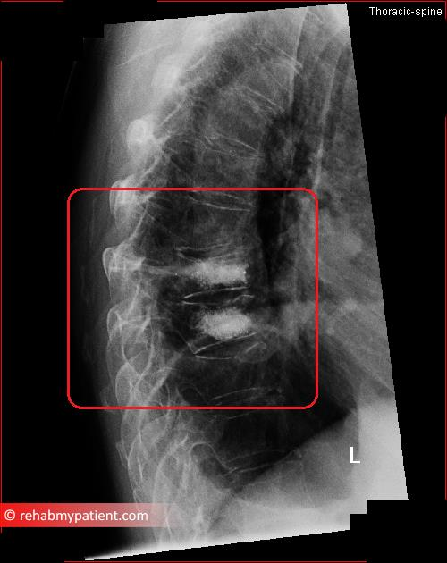 Kyphoplasty | Rehab My Patient