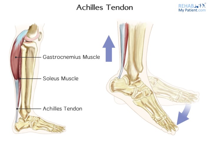 Achilles Tendinopathy | Rehab My Patient