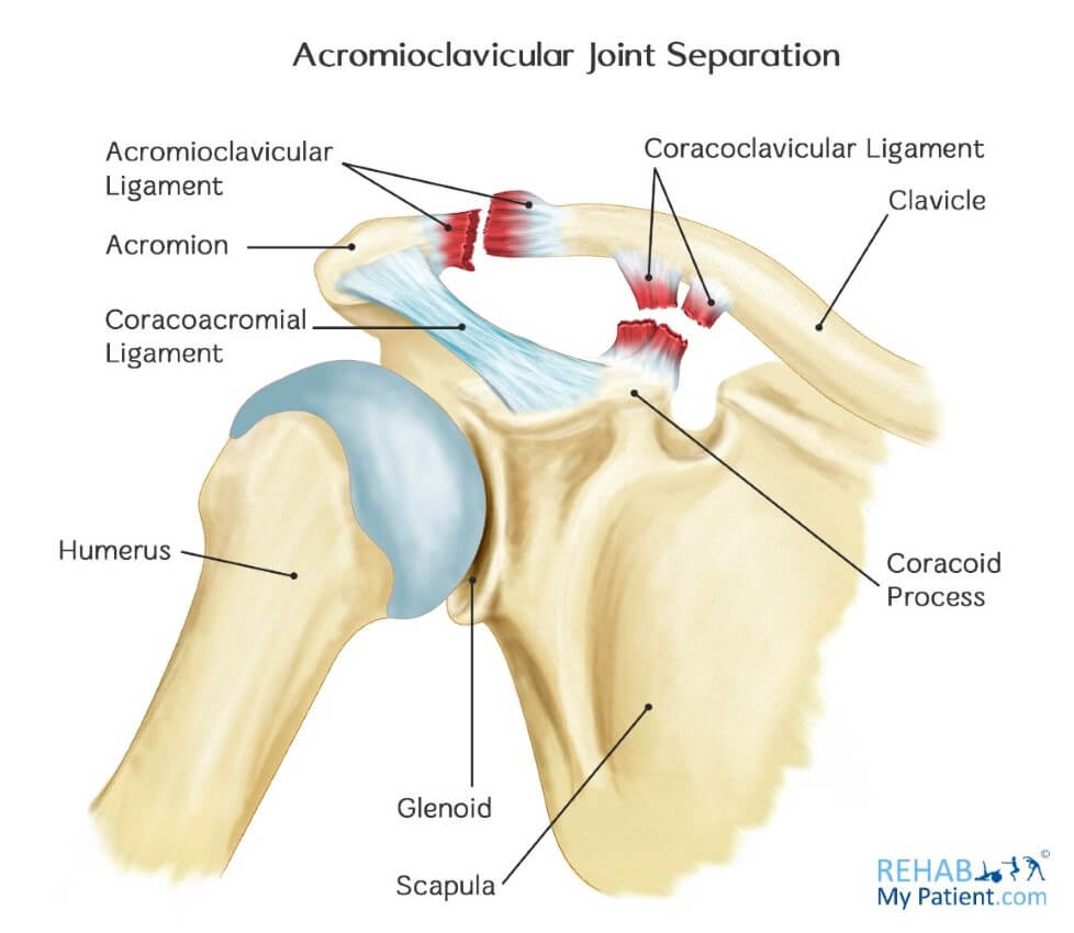 Acromioclavicular Joint Separation | Rehab My Patient