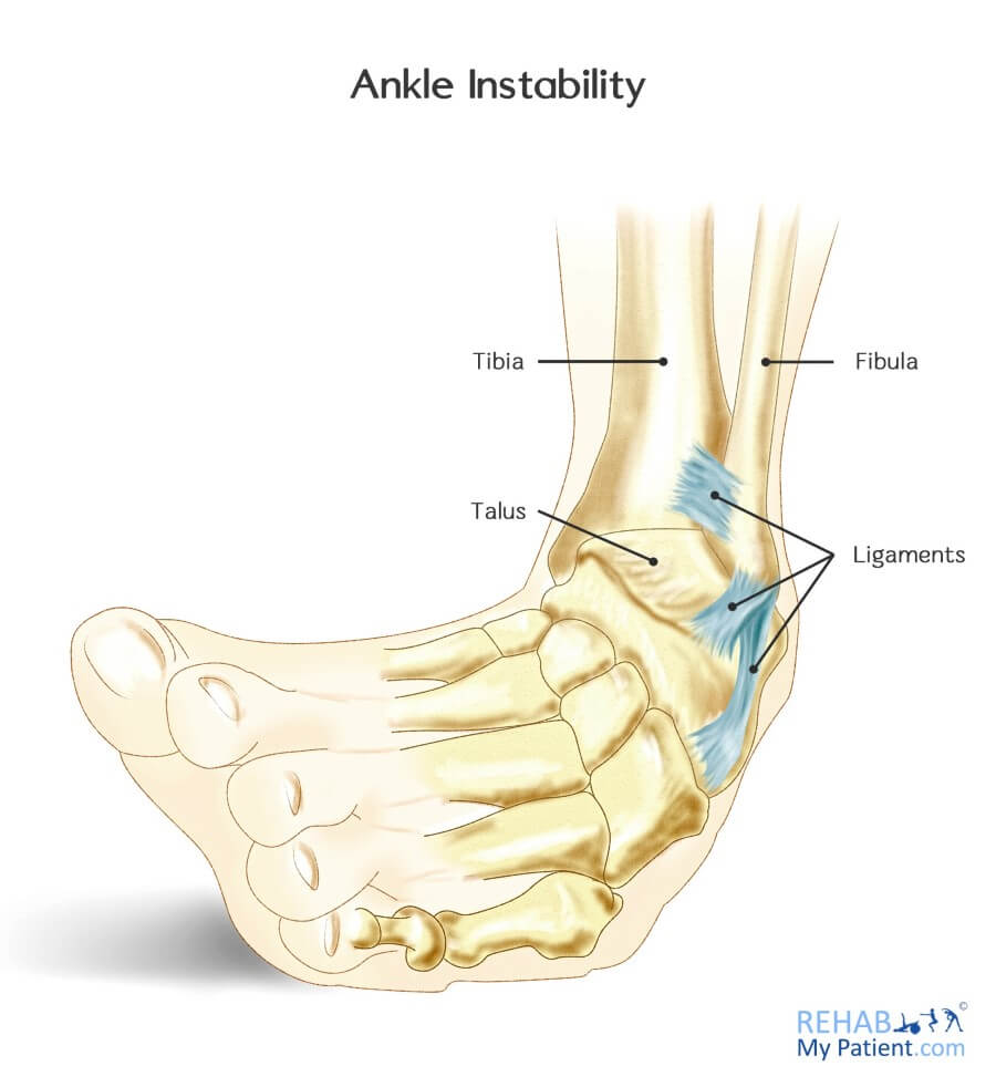 Ankle Sprains (Medial and Lateral)
