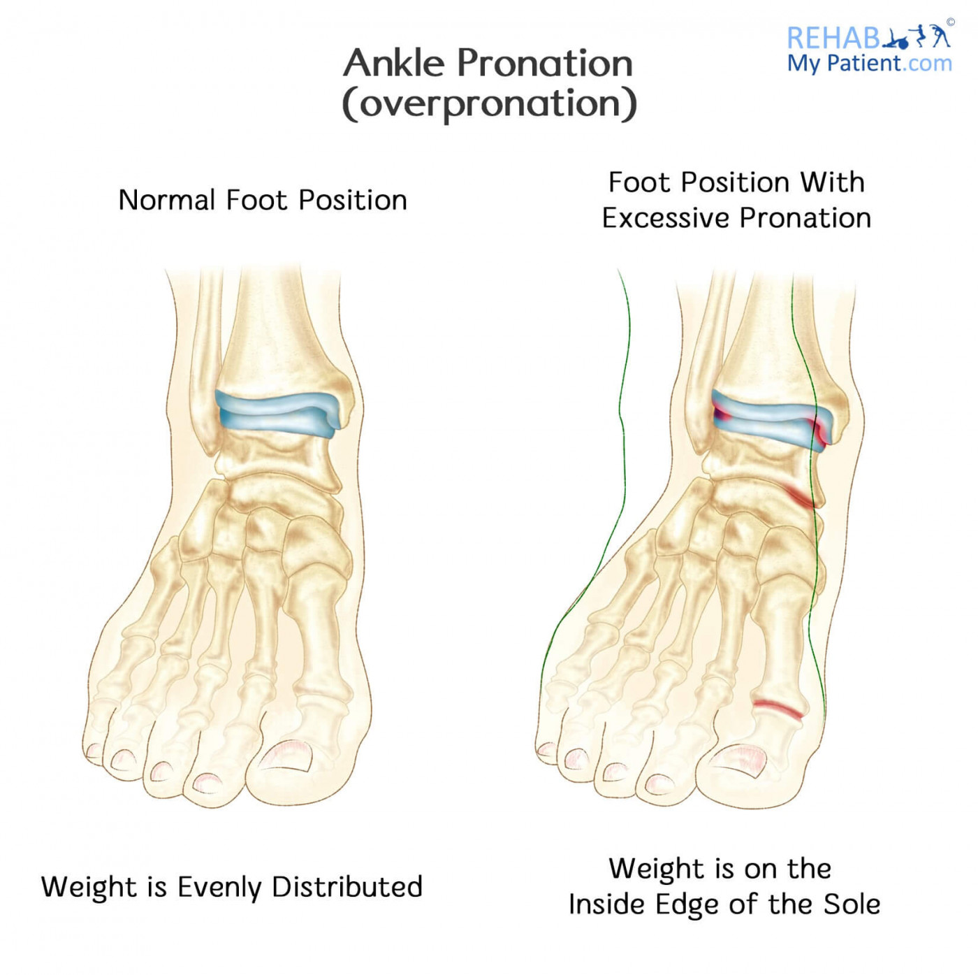 Ankle Pronation
