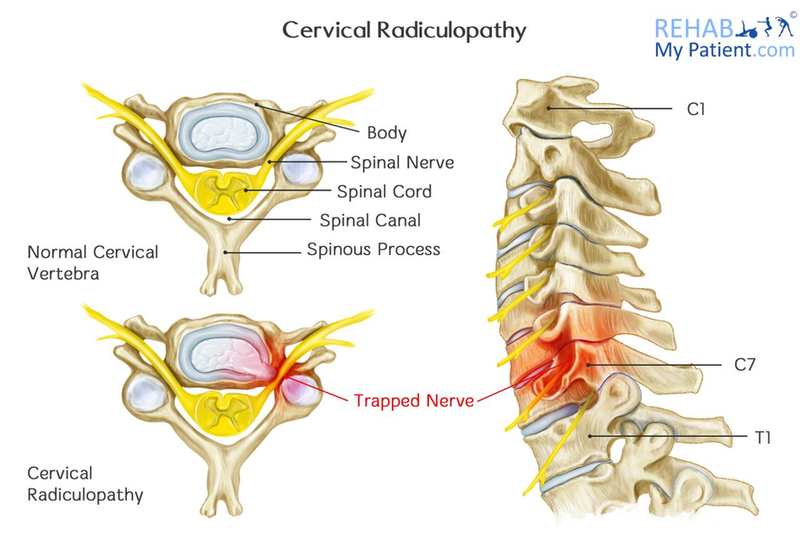 Radiculopatía cervical (nervio pinzado) (Cervical Radiculopathy (Pinched  Nerve)) - OrthoInfo - AAOS