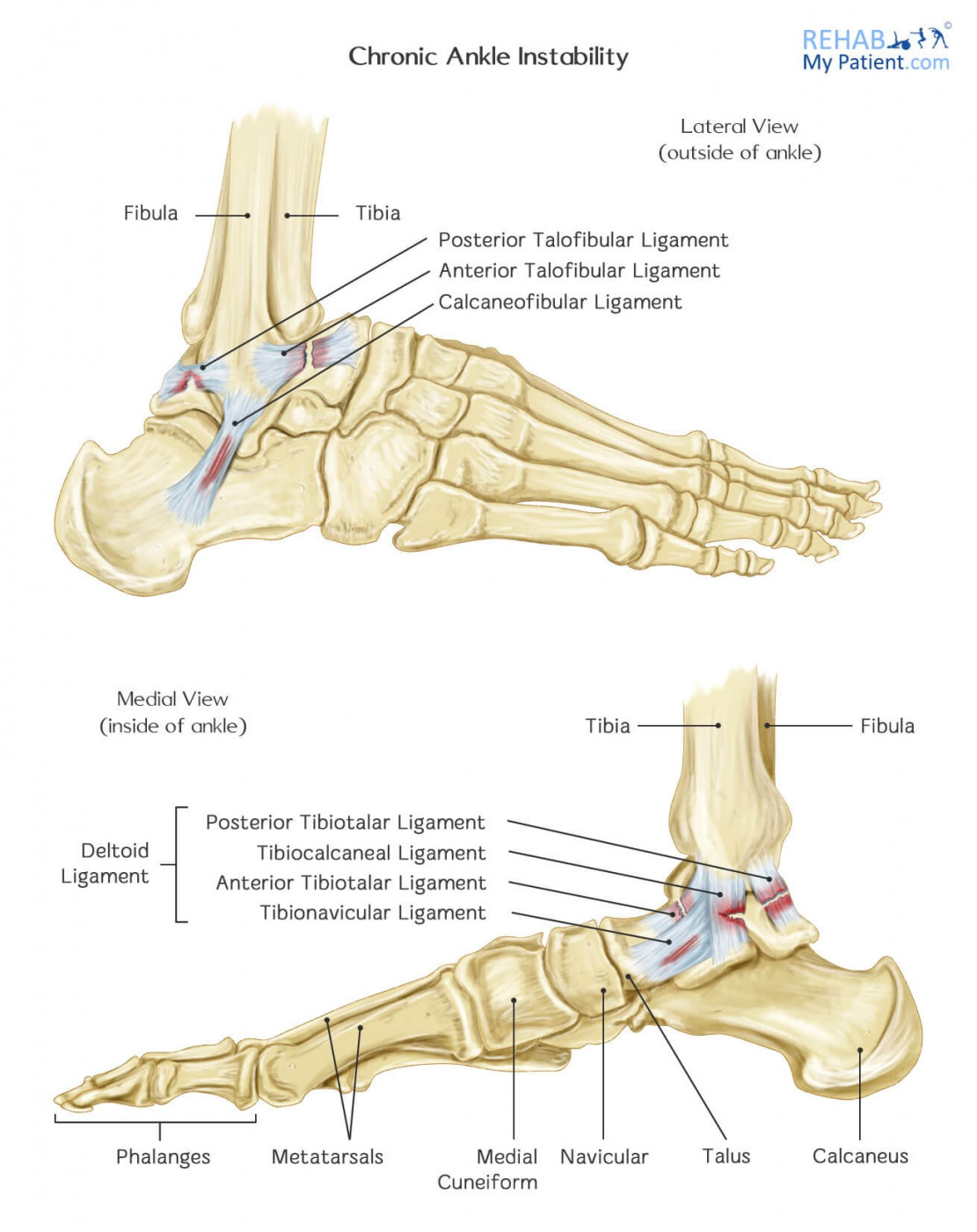 What Is Chronic Ankle Instability? - Rural Physio at Your Doorstep