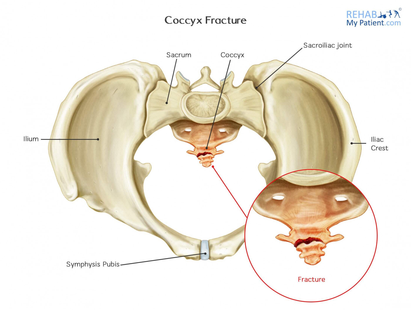 Tailbone (Coccyx) Pain RELIEF, vertebral column