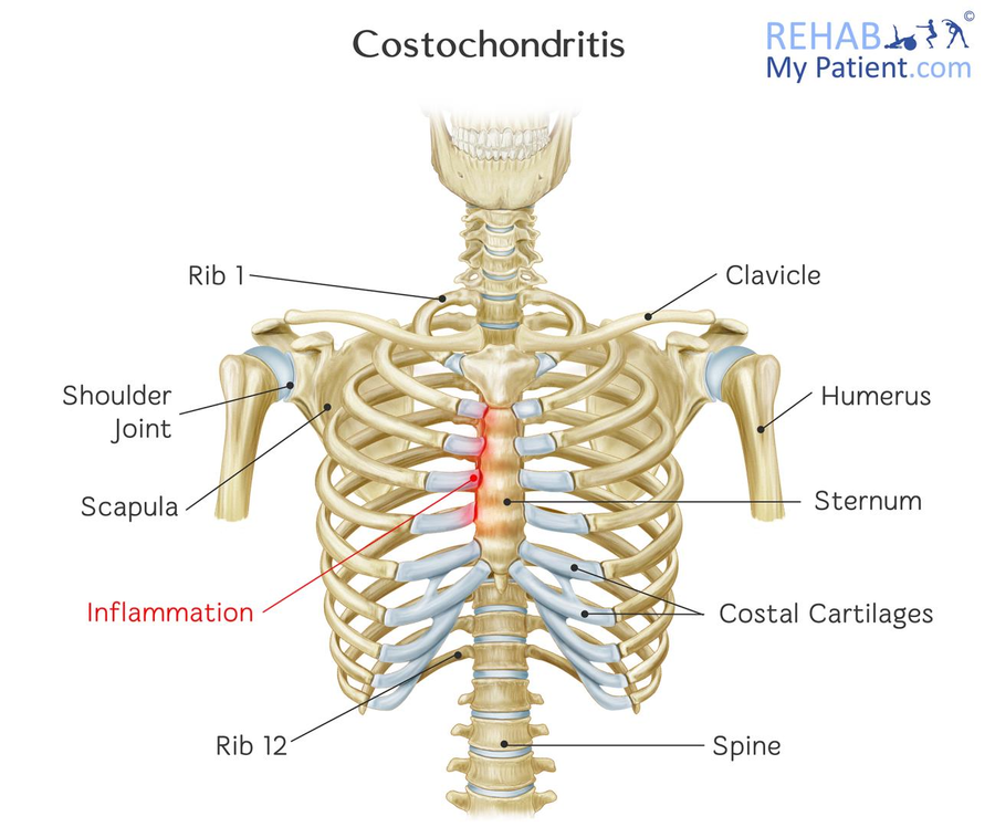 Costochondritis  Rehab My Patient