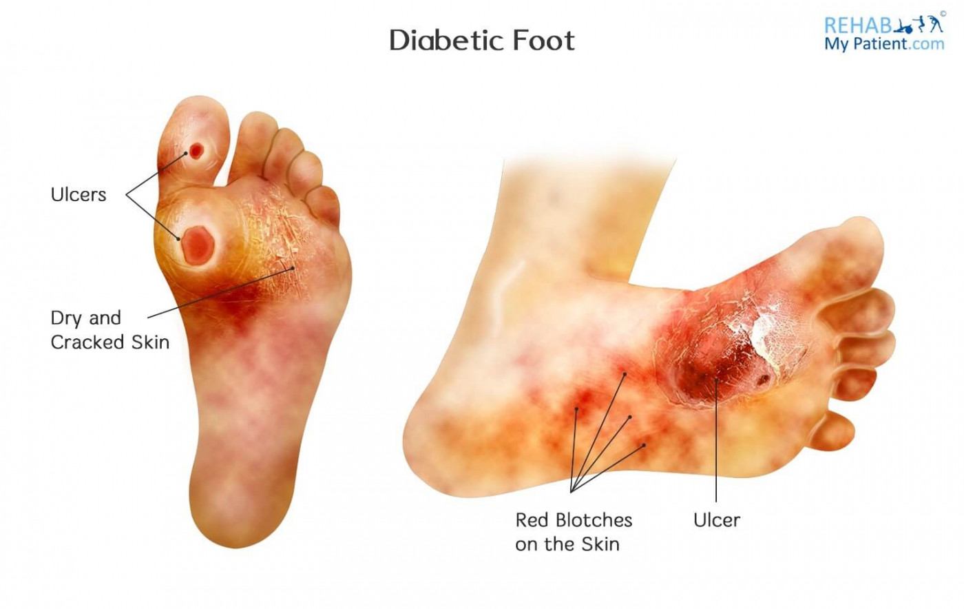 Diabetic Charcot Foot Rehab My Patient