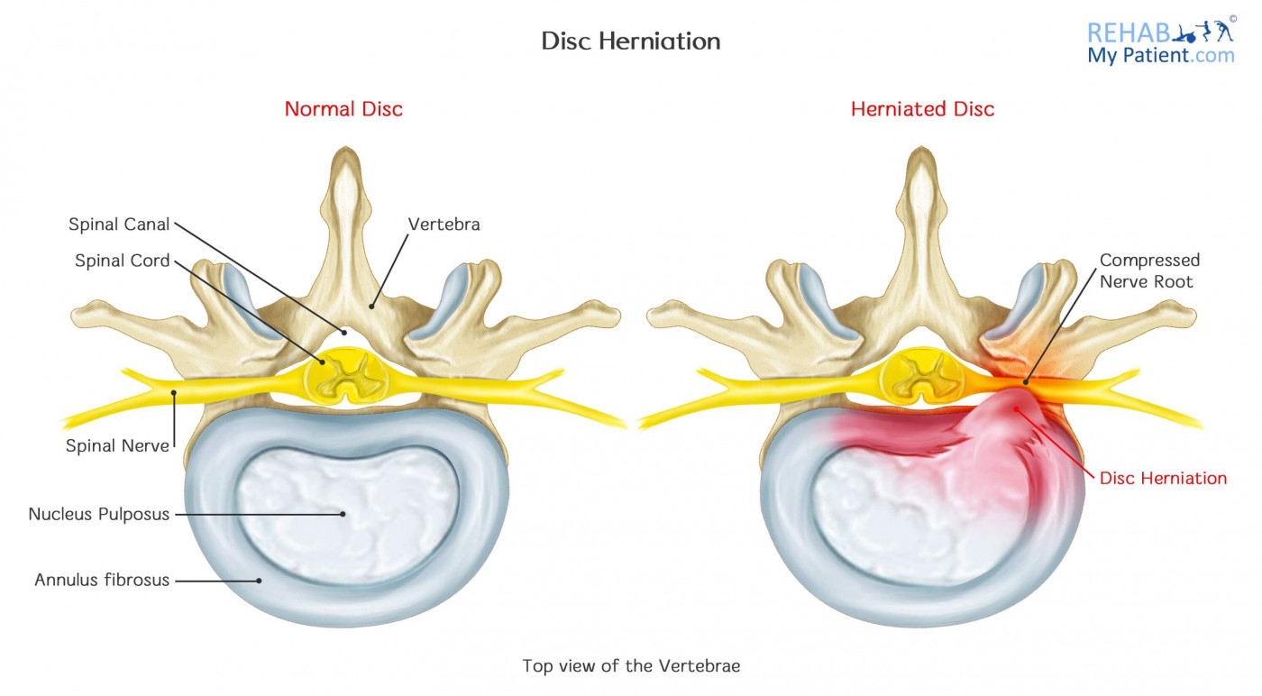 Disc Herniation Rehab My Patient