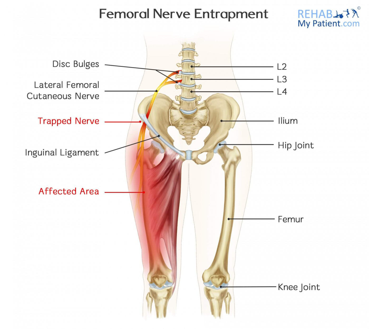 pinched nerve in leg