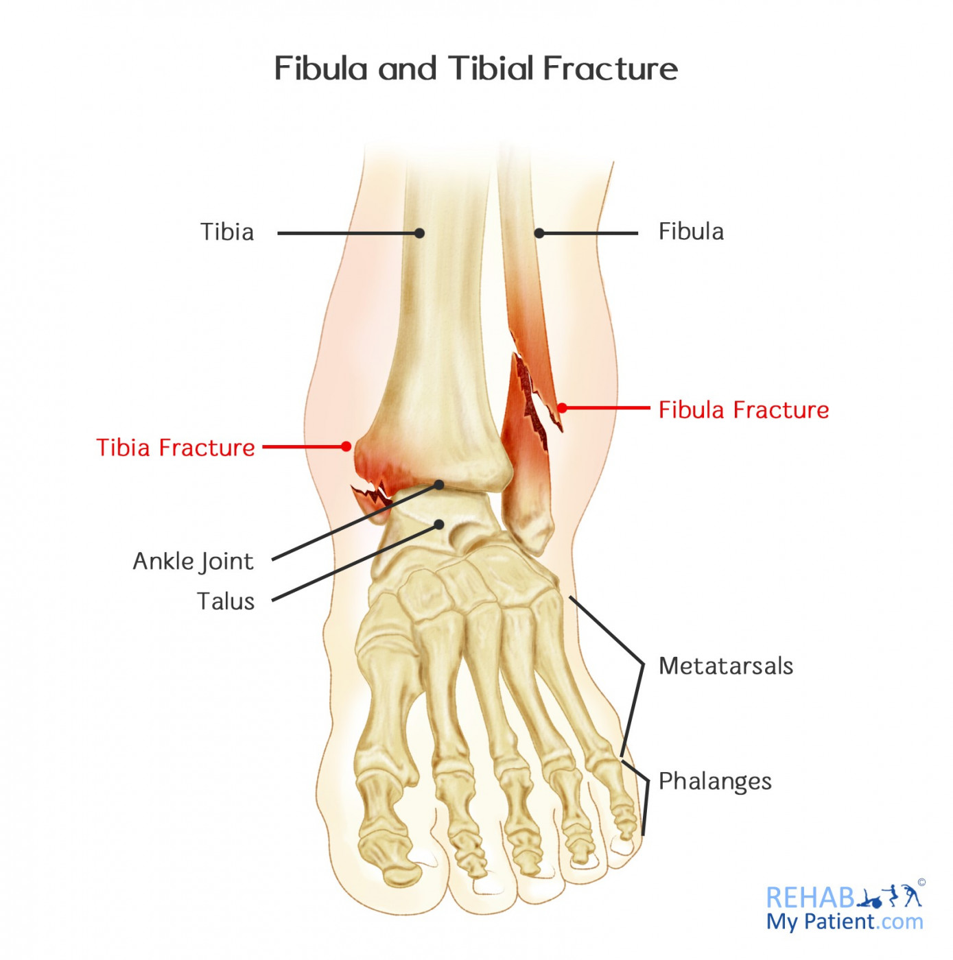 spiral fracture distal fibula
