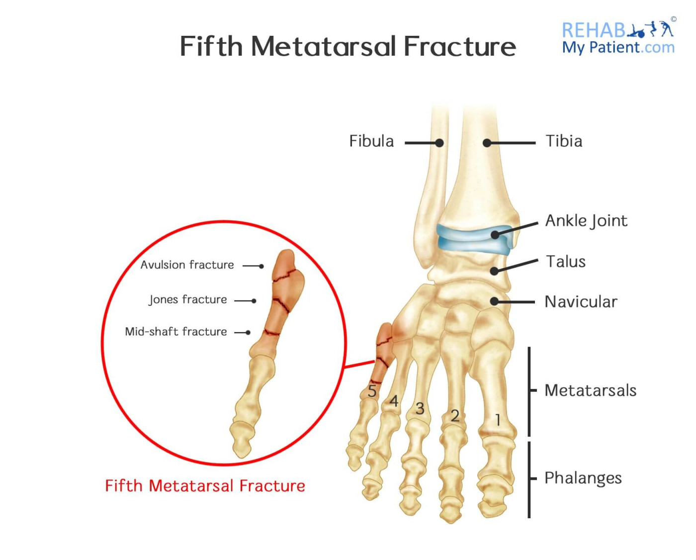 5th metatarsal fracture healing time