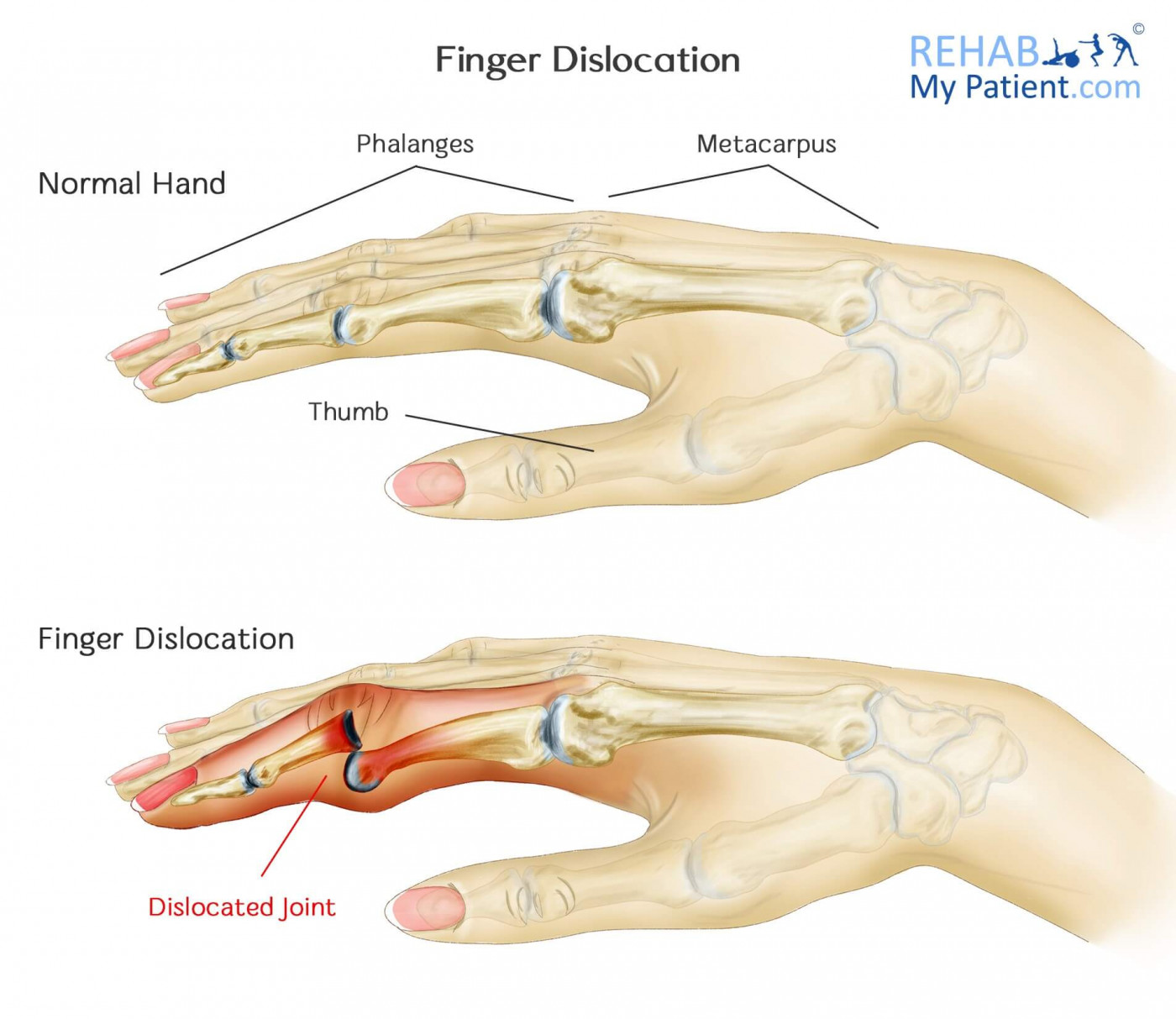 Finger Dislocation | Rehab My Patient