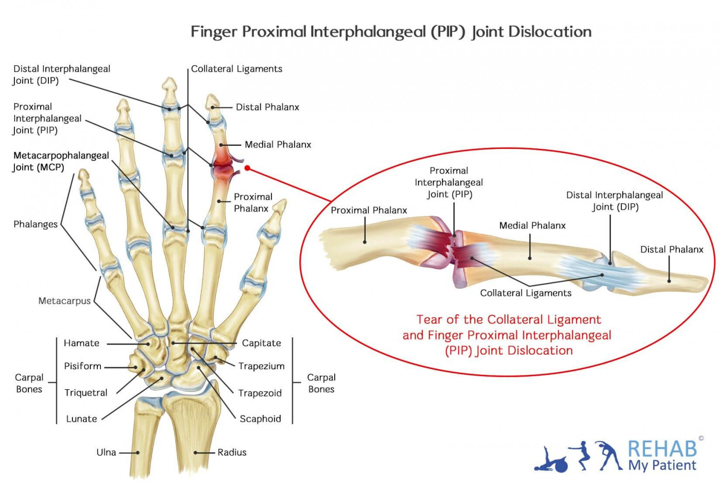 Collateral Ligament Finger