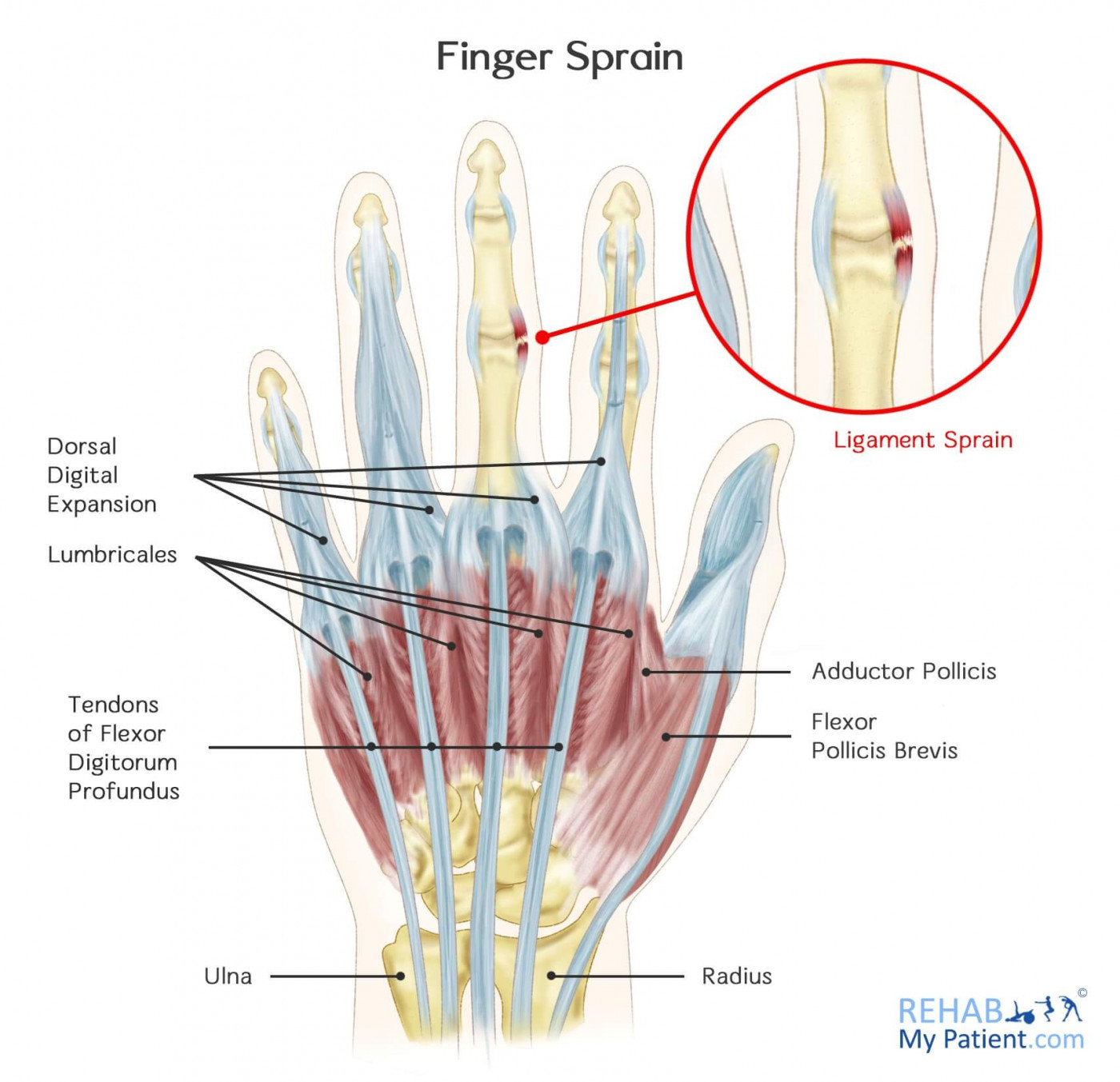 Sprained Index Finger