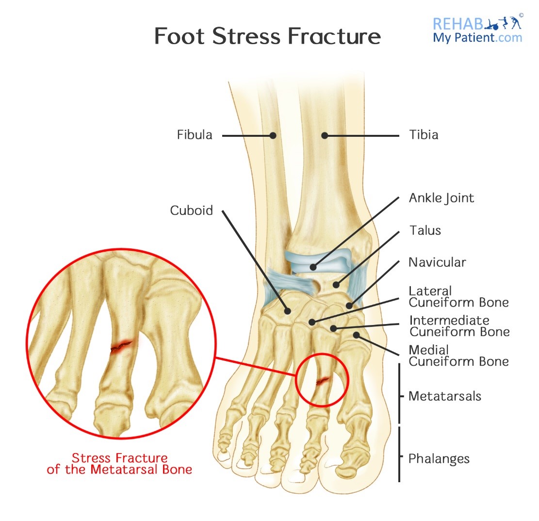hairline fracture in foot