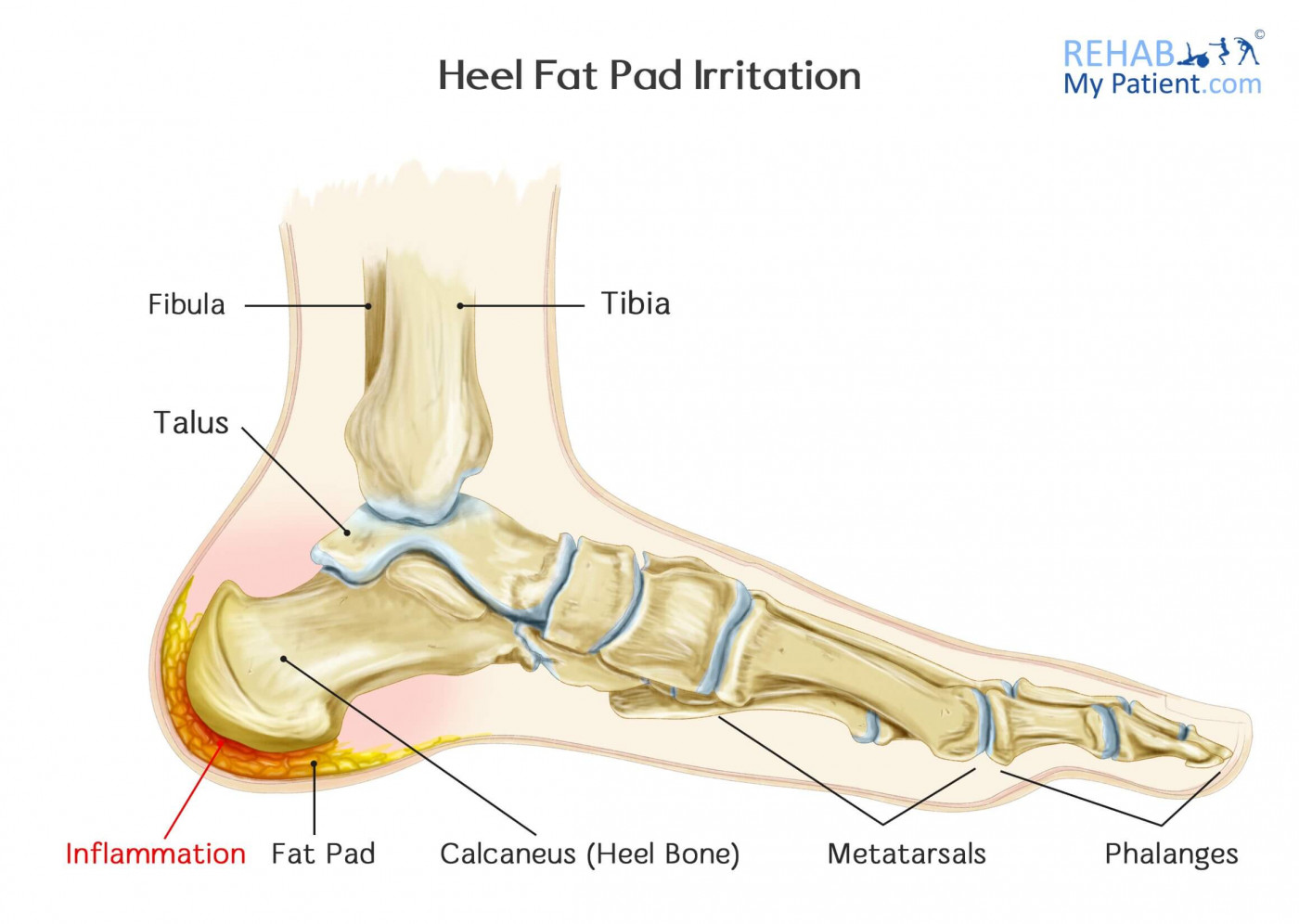 Running and Track Injuries to the Foot and Ankle, Glendale, AZ - Sole Foot  & Ankle Specialists