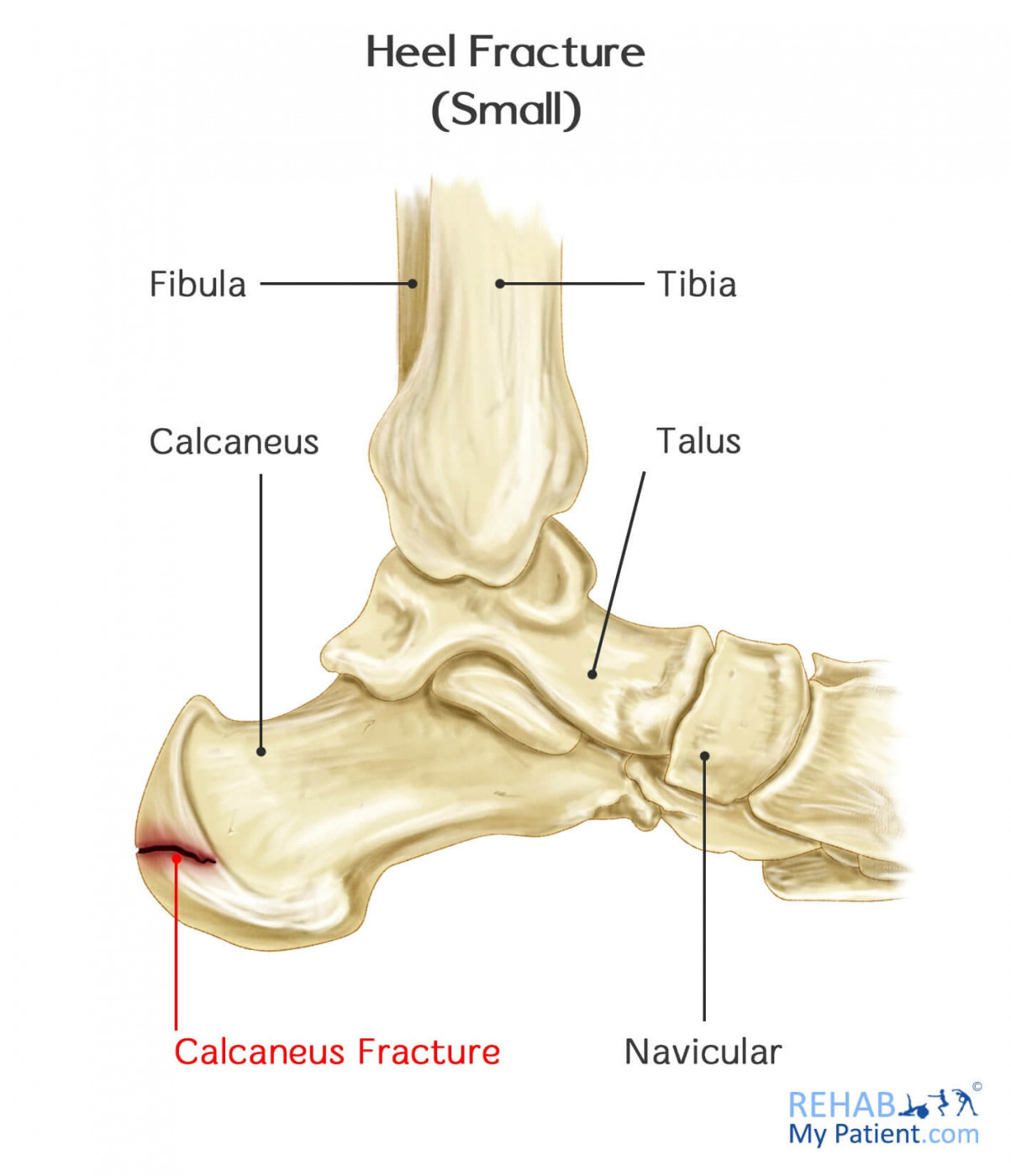 heel stress fracture treatment