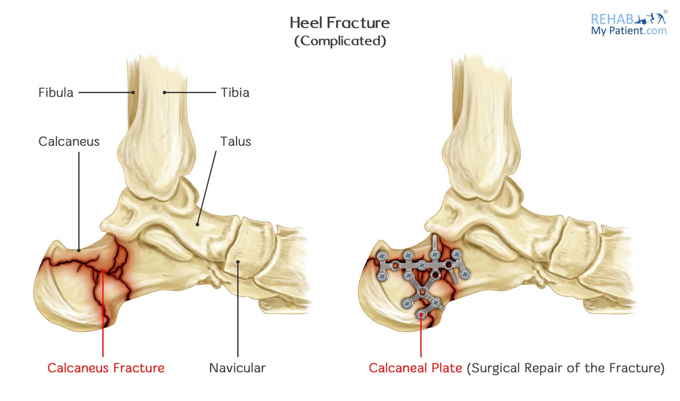 Heel Fracture Complicated