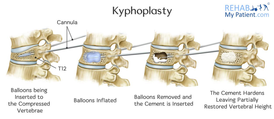 Kyphoplasty | Rehab My Patient