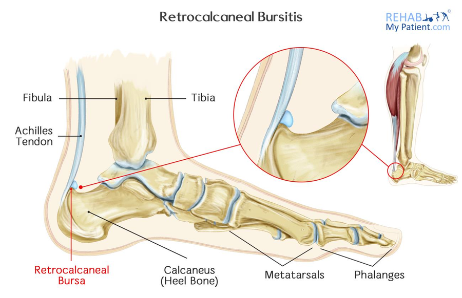 Retrocalcaneal Bursitis | Rehab My Patient