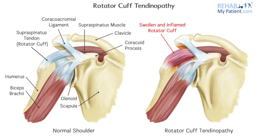 Rotator Cuff Tendinopathy Rehab My Patient